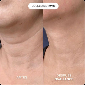 Kit de Micro-Infusión Antiedad