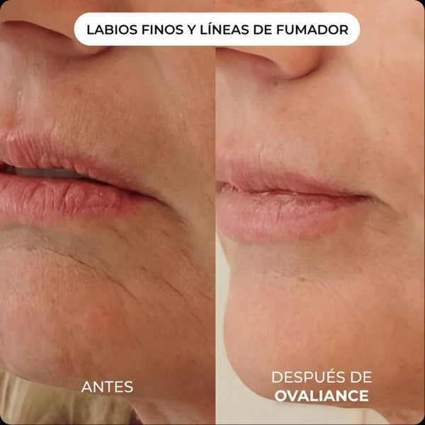 Kit de Micro-Infusión Antiedad